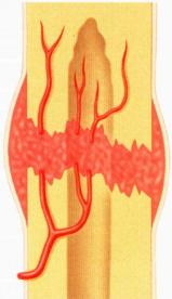 Формирование кровяного сгустка в кости 