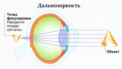 Дальнозоркость