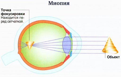 Миопия