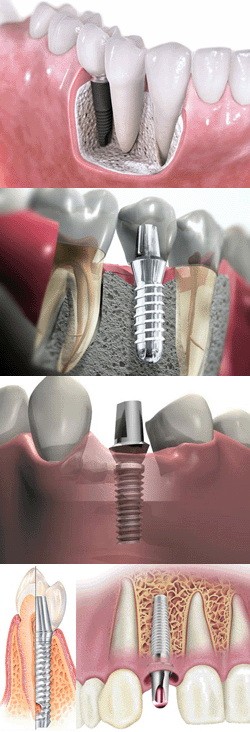 Имплантация зубов