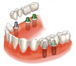 Имплантация зубов